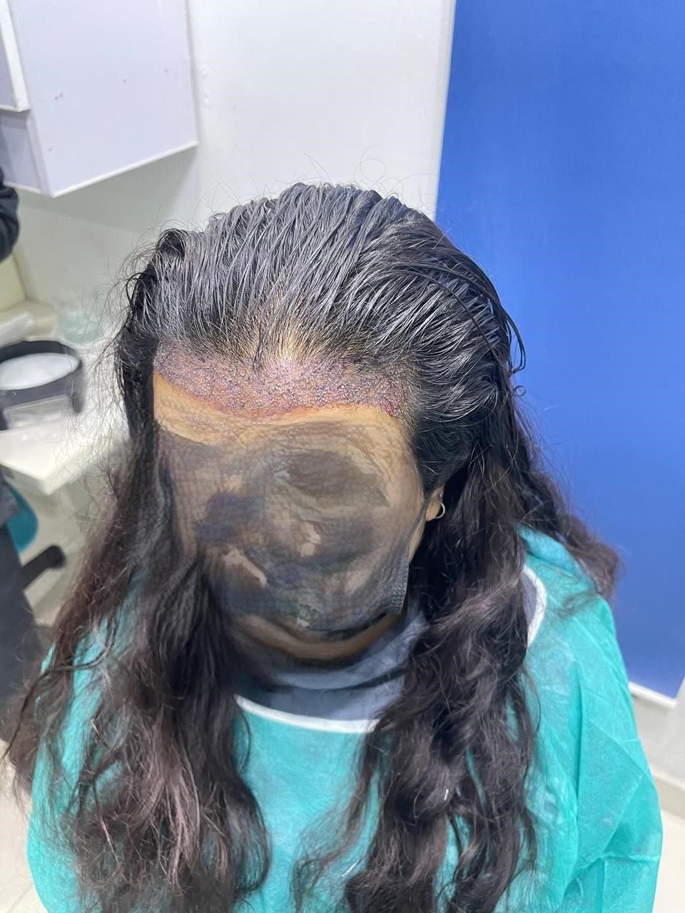Before PRP Hairfall Treatment