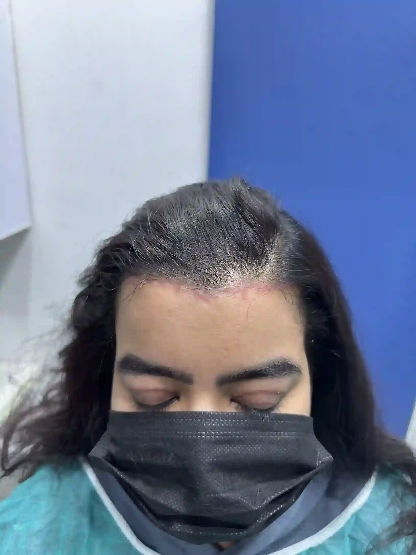 After PRP Hairfall Treatment