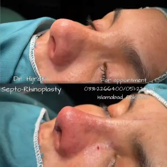 Rhinoplasty