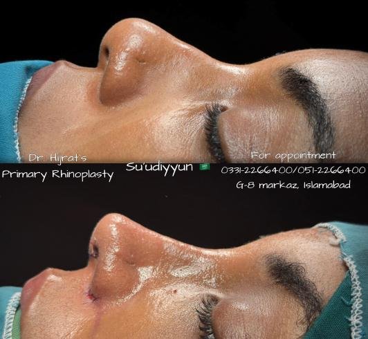 Before Rhinoplasty
