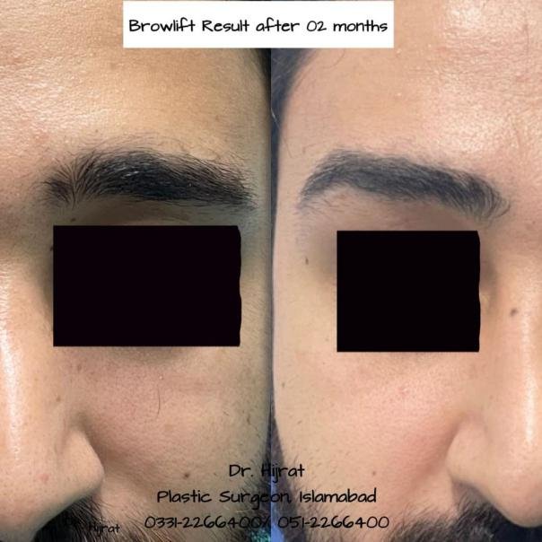 After Brow / Forehead Lift