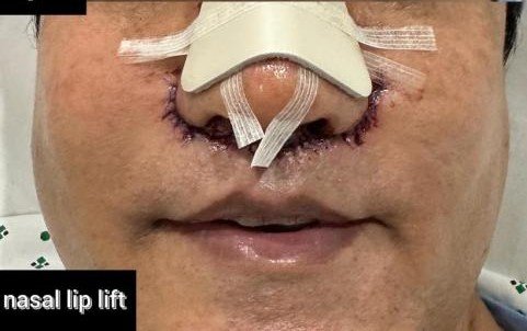 After Subnasal Lip Lift