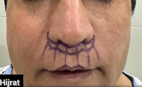 Before Subnasal Lip Lift