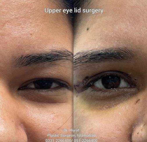 Before Eyelid Surgery