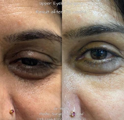 After Eyelid Surgery