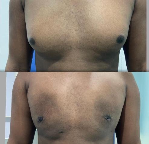 After Gynecomastia Surgery