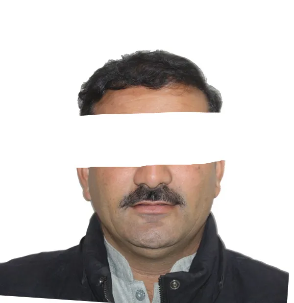 Hair Transplant