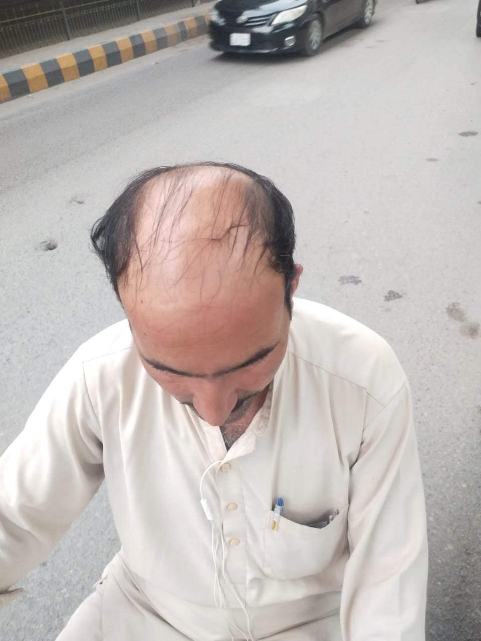 Before Hair Transplant