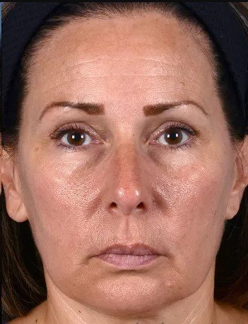Before Laser Treatment